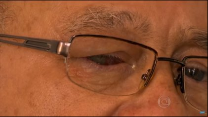 Mutirão de cirurgia de catarata deixa mais de 20 contaminados por bactéria; Idosos perderam a visão